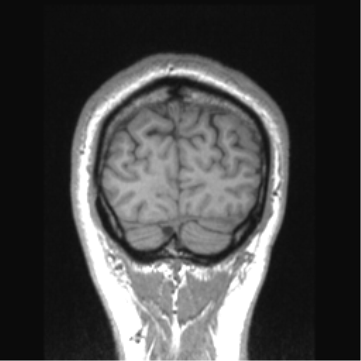 Cerebral arteriovenous malformation (Radiopaedia 39259-41506 Coronal T1 13).png