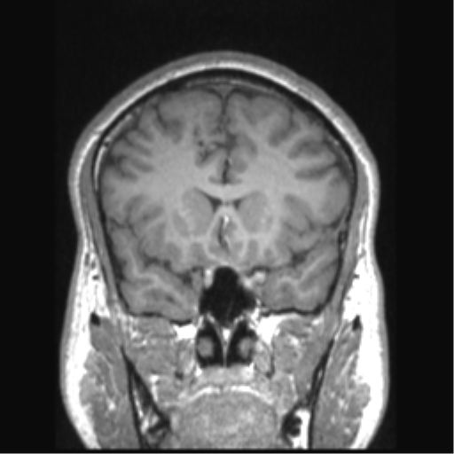 File:Cerebral arteriovenous malformation (Radiopaedia 39259-41506 Coronal T1 62).png