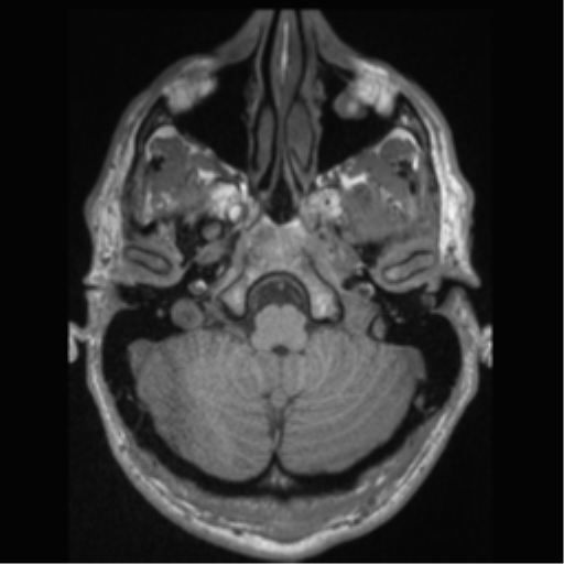 Cerebral arteriovenous malformation (Radiopaedia 55798-62372 Axial T1 8).png