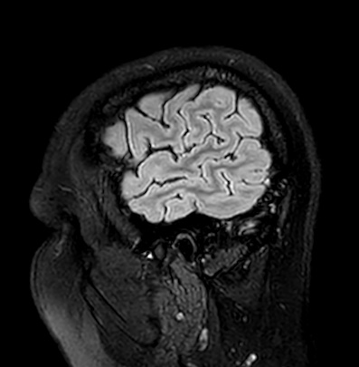 Cerebral arteriovenous malformation (Radiopaedia 74411-85746 Sagittal FLAIR 10).jpg