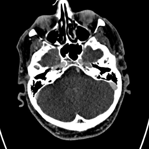 Cerebral arteriovenous malformation (Radiopaedia 78188-90746 Axial C+ delayed 39).jpg