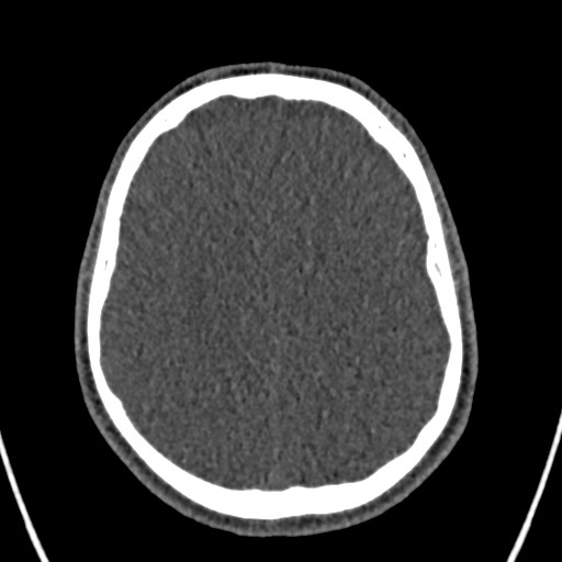 Cerebral arteriovenous malformation (Radiopaedia 78188-90746 Axial non-contrast 126).jpg