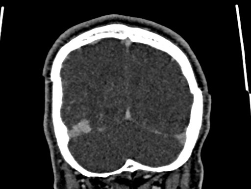 File:Cerebral arteriovenous malformation (Radiopaedia 78188-90746 Coronal C+ delayed 108).jpg