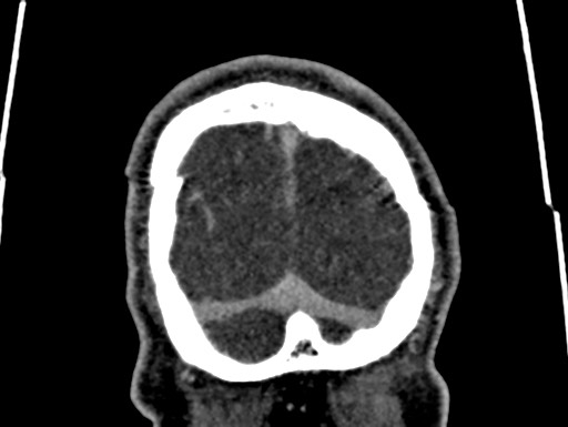 Cerebral arteriovenous malformation (Radiopaedia 78188-90746 Coronal C+ delayed 119).jpg