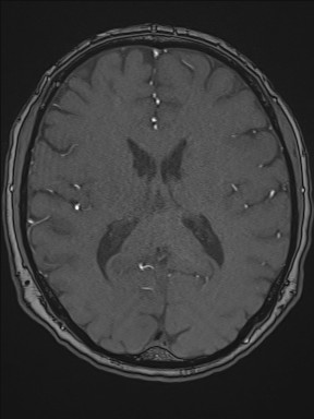 Cerebral arteriovenous malformation (Radiopaedia 84015-99245 Axial TOF 141).jpg