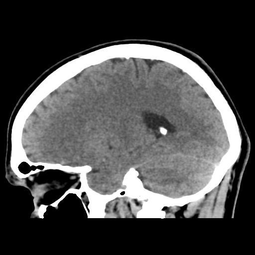 File:Cerebral arteriovenous malformation (Spetzler-Martin grade 2) (Radiopaedia 41262-44076 A 40).png