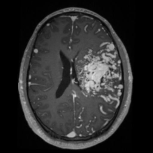 Cerebral arteriovenous malformation - huge (Radiopaedia 35734-37272 Axial T1 C+ 44).png