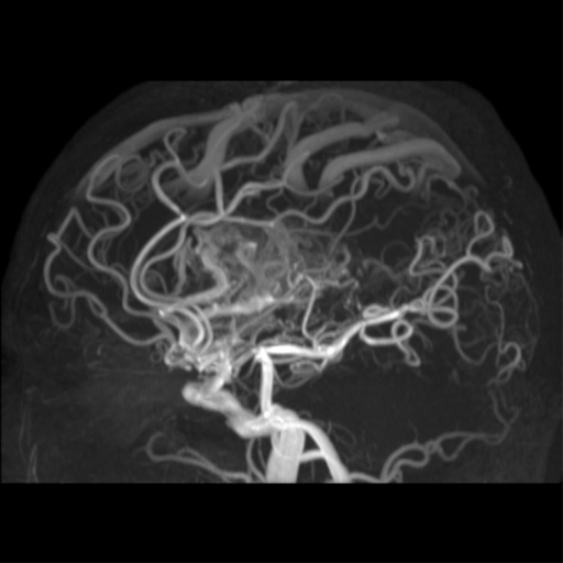 File:Cerebral arteriovenous malformation - huge (Radiopaedia 35734-37272 MRA 20).png