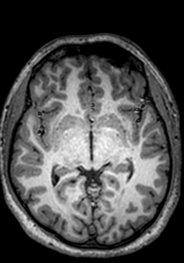 File:Cerebral arteriovenous malformation at posterior body of corpus callosum (Radiopaedia 74111-84925 Axial T1 164).jpg