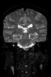 Cerebral arteriovenous malformation at posterior body of corpus callosum (Radiopaedia 74111-84925 Coronal T2 105).jpg