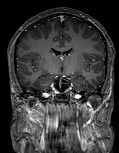 Cerebral arteriovenous malformation at posterior body of corpus callosum (Radiopaedia 74111-84925 K 175).jpg