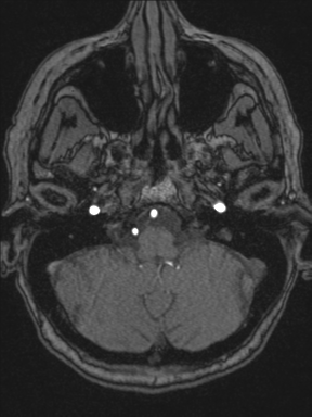 Cerebral arteriovenous malformation with hemorrhage (Radiopaedia 34422-35737 Axial MRA 13).png