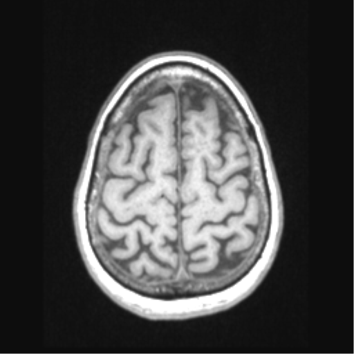 Cerebral arteriovenous malformation with hemorrhage (Radiopaedia 34422-35737 Axial T1 63).png