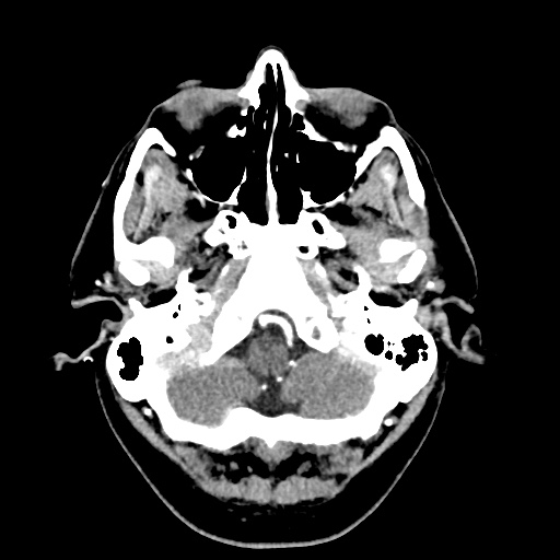 Cerebral arteriovenous malformation with lobar hemorrhage (Radiopaedia 35598-57216 A 8).jpg
