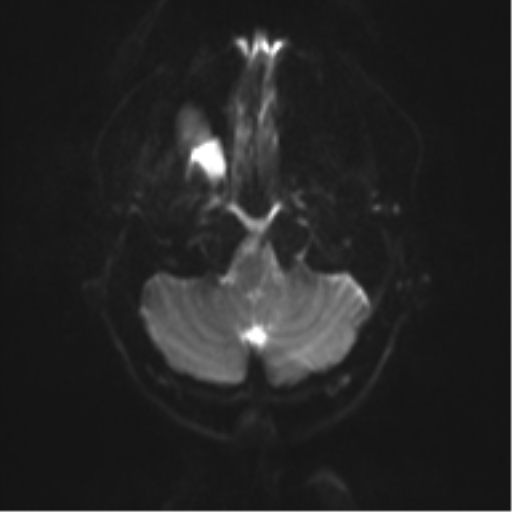 File:Cerebral cavernoma and development venous anomaly (Radiopaedia 37603-39482 Axial DWI 4).png