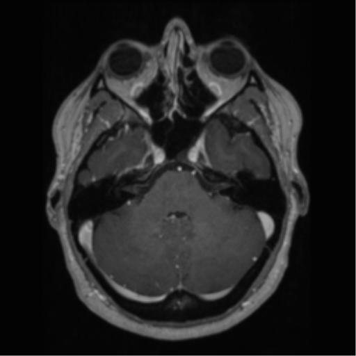 Cerebral cavernoma and development venous anomaly (Radiopaedia 37603-39482 Axial T1 C+ 21).png