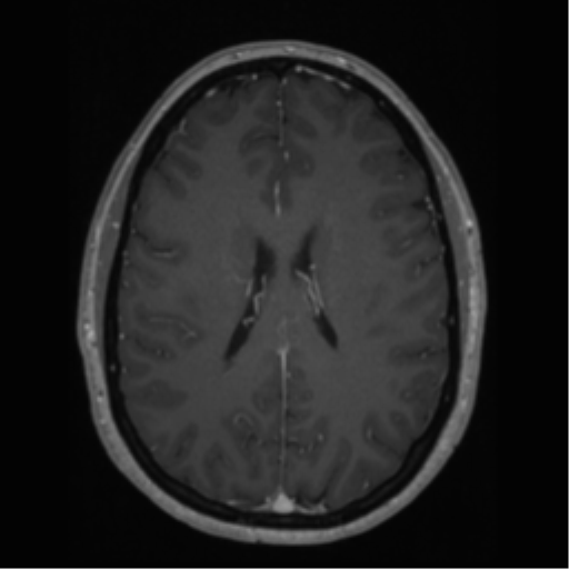 Cerebral cavernoma and development venous anomaly (Radiopaedia 37603-39482 Axial T1 C+ 47).png
