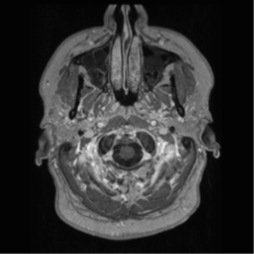 File:Cerebral cavernoma and development venous anomaly (Radiopaedia 37603-39482 Axial T1 C+ 6).png