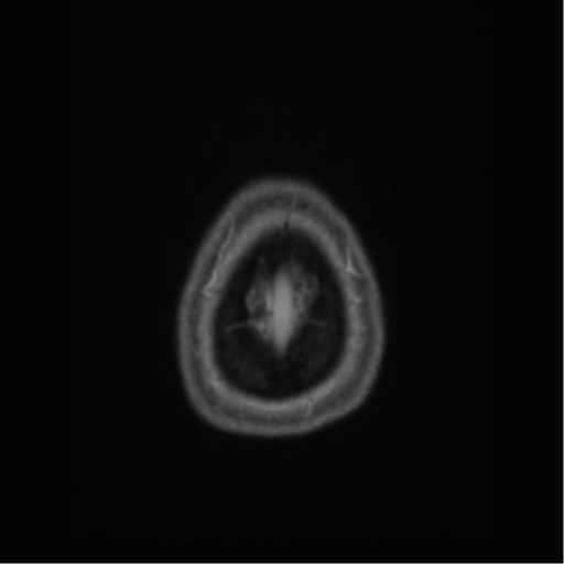 Cerebral cavernoma and development venous anomaly (Radiopaedia 37603-39482 Axial T1 C+ 75).png