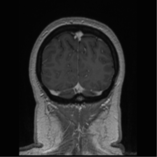 Cerebral cavernoma and development venous anomaly (Radiopaedia 37603-39482 Coronal T1 C+ 15).png