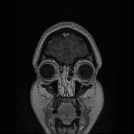 Cerebral cavernoma and development venous anomaly (Radiopaedia 37603-39482 Coronal T1 C+ 84).png