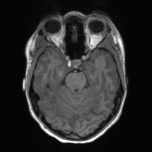 Cerebral cavernous venous malformation (Radiopaedia 70008-80021 Axial T1 23).jpg