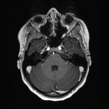 Cerebral cavernous venous malformation (Radiopaedia 70008-80021 Axial T1 C+ 17).jpg