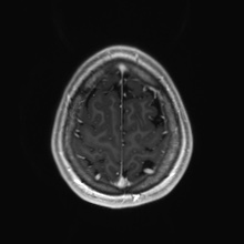 Cerebral cavernous venous malformation (Radiopaedia 70008-80021 Axial T1 C+ 90).jpg