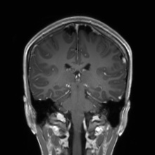 Cerebral cavernous venous malformation (Radiopaedia 70008-80021 Coronal T1 C+ 26).jpg