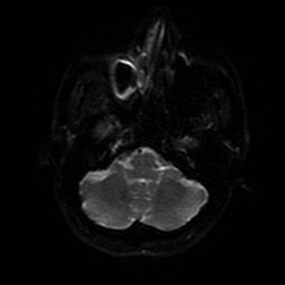 Cerebral cavernous venous malformation (Zabramski type II) (Radiopaedia 85511-101198 Axial DWI 74).jpg