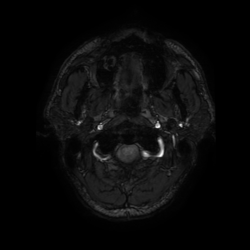 Cerebral cavernous venous malformation (Zabramski type II) (Radiopaedia 85511-101198 Axial SWI 4).jpg