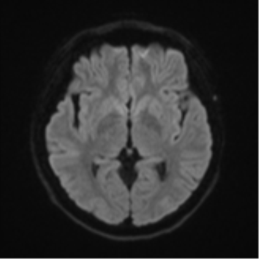 Cerebral cavernous venous malformations (Radiopaedia 48117-52946 Axial DWI 41).png