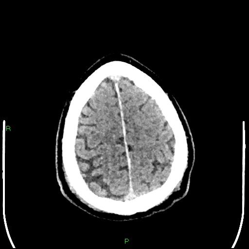 Cerebral contusions (Radiopaedia 33868-35039 Axial non-contrast 185).jpg