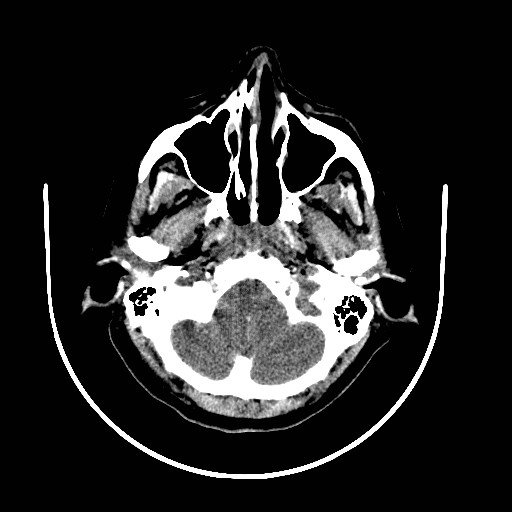File:Cerebral edema (evolution in time) (Radiopaedia 19418-19439 non-contrast 12).jpg
