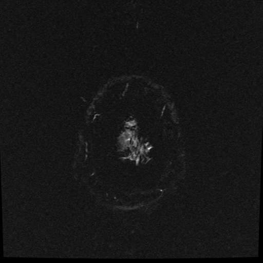 Cerebral embolic infarcts (embolic shower) (Radiopaedia 49837-55108 Axial SWI 3).jpg