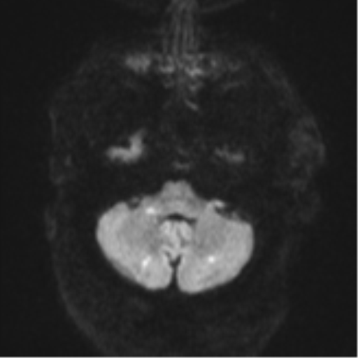 File:Cerebral embolic infarcts (embolic shower) (Radiopaedia 57395-64342 Axial DWI 44).png