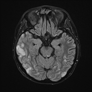 File:Cerebral embolic infarcts (embolic shower) (Radiopaedia 72391-82921 Axial FLAIR 12).jpg