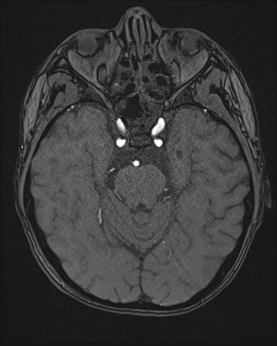 Cerebral embolic infarcts (embolic shower) (Radiopaedia 72391-82921 Axial MRA 48).jpg