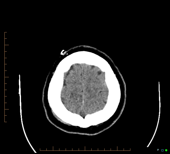 Cerebral fat embolism (Radiopaedia 85521-101220 Axial non-contrast 53).jpg