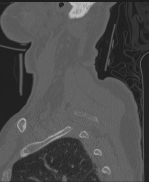 Cerebral hemorrhagic contusions and cervical spine fractures (Radiopaedia 32865-33841 Sagittal bone window 8).jpg