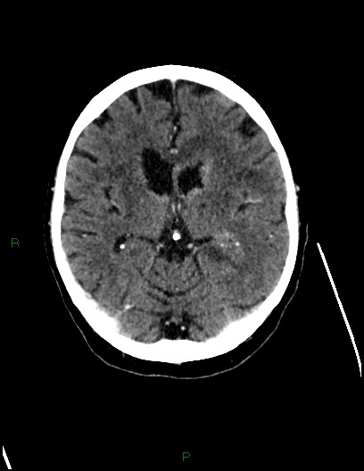 File:Cerebral metastases - ependymal and parenchymal (Radiopaedia 79877-93131 Axial C+ delayed 42).jpg