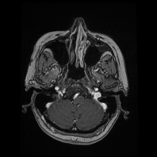 File:Cerebral metastases - melanoma (Radiopaedia 80972-94522 Axial T1 C+ 30).jpg