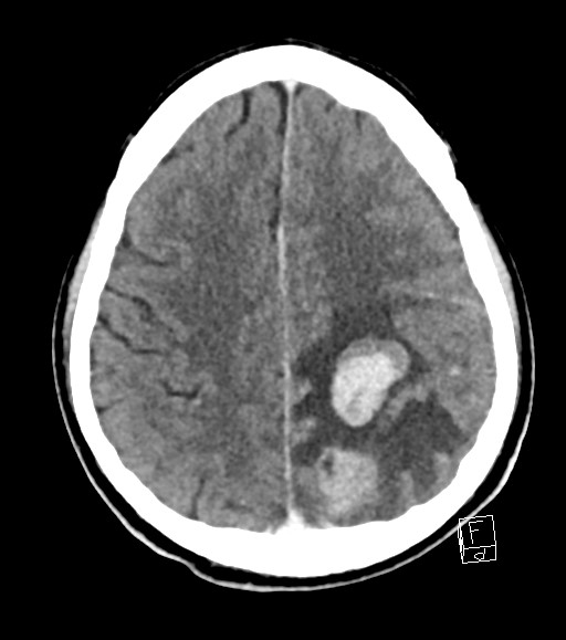 Cerebral metastases - testicular choriocarcinoma (Radiopaedia 84486-99855 Axial C+ delayed 19).jpg