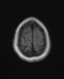 File:Cerebral metastases mimicking abscesses (Radiopaedia 45841-50131 Axial T1 26).png