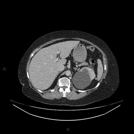 File:Cerebral metastasis from renal cell carcinoma (Radiopaedia 82306-96378 A 47).jpg