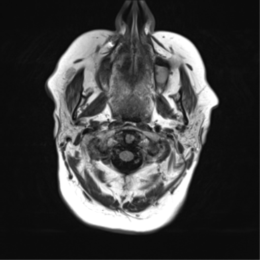 File:Cerebral metastasis mimicking glioblastoma (Radiopaedia 69155-78937 Axial FLAIR 2).png
