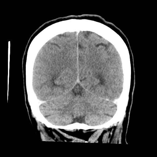 Cerebral metastasis to basal ganglia (Radiopaedia 81568-95412 Coronal C+ delayed 48).png