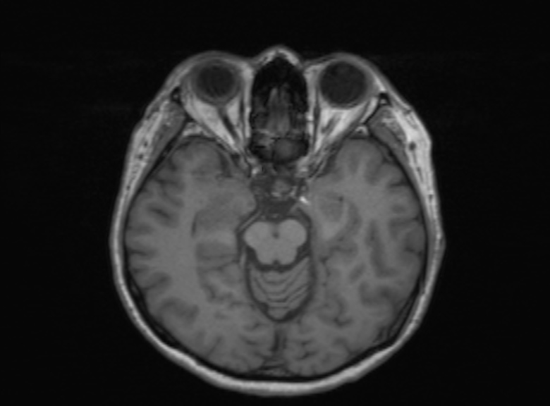 Cerebral ring enhancing lesions - cerebral metastases (Radiopaedia 44922-48817 Axial T1 265).jpg