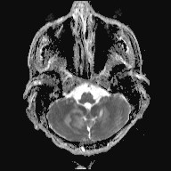 File:Cerebral toxoplasmosis (Radiopaedia 43956-47461 Axial ADC 3).jpg