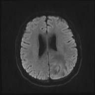 File:Cerebral toxoplasmosis (Radiopaedia 43956-47461 Axial DWI 14).jpg
